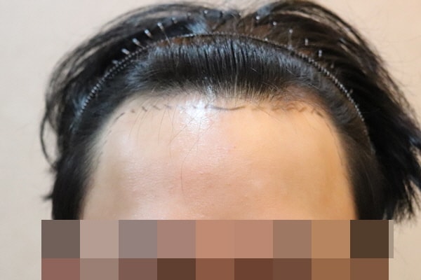 JP성형외과 비절개 2300모 1년차 후기