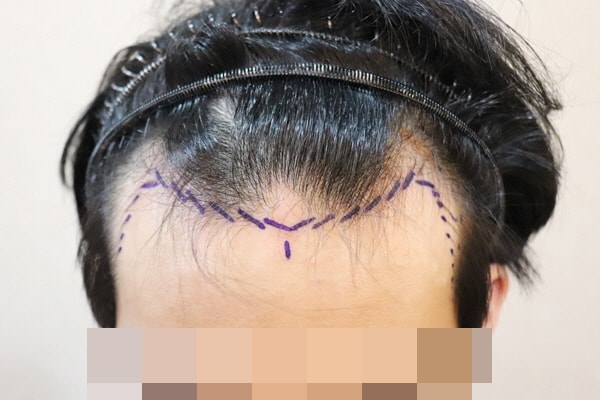 모발이식 벌써1년 수술잘한거 같습니다