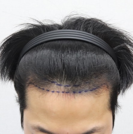 It's been 3 years since Mo Plus's incision