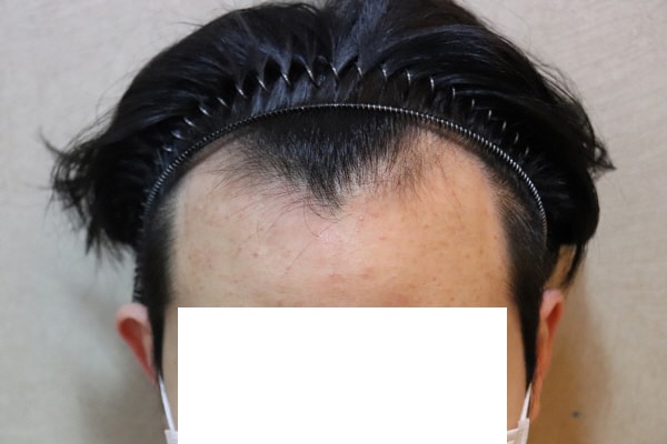 jp성형외과 2주차 후기