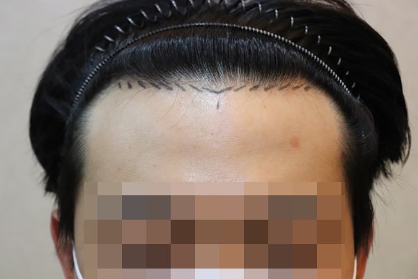 수술 15일차 사진입니다