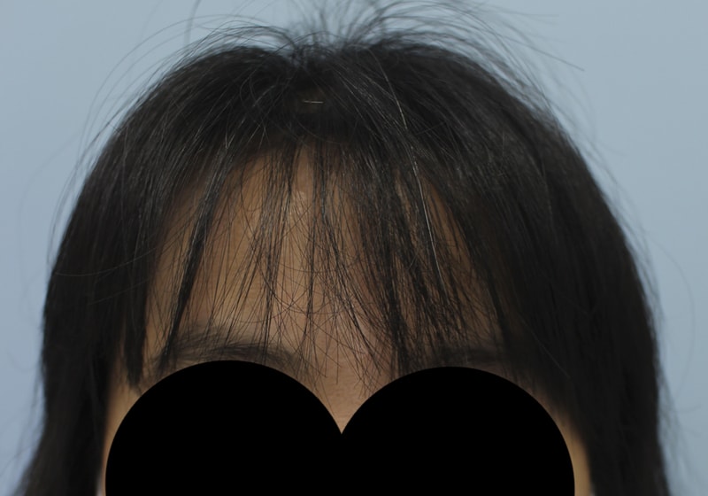 The review of the hairline transplant and post it up!!