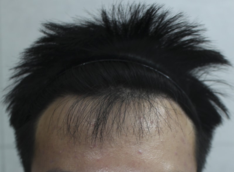 切開2400毛記録7ヶ月です…!!