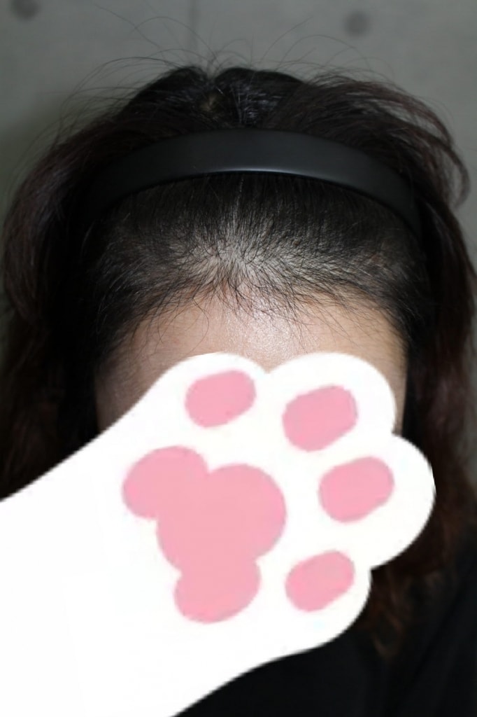 헤어라인 5개월 후기올려봐용~~