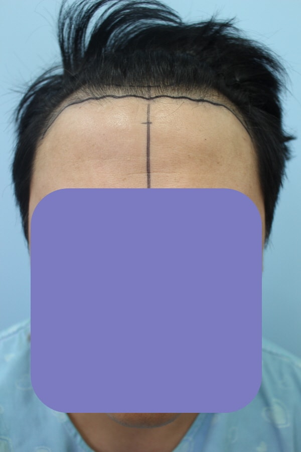 I got a transplant, but I don't know what it'll be like