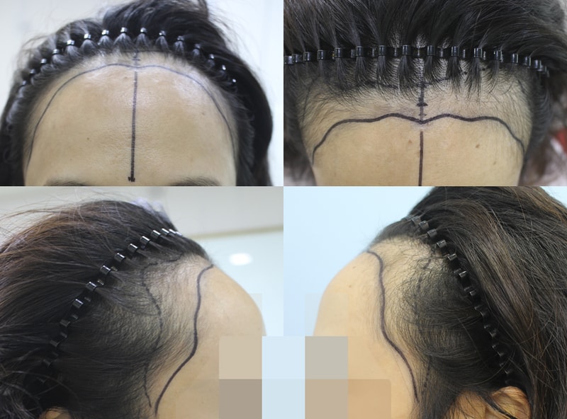 ハンナイブでヘアライン矯正をしました~