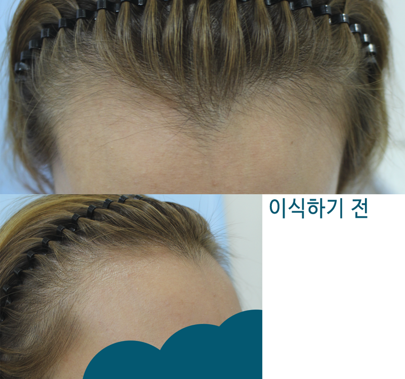 ヘアライン移植しました~^^ デザインと一緒に見てください