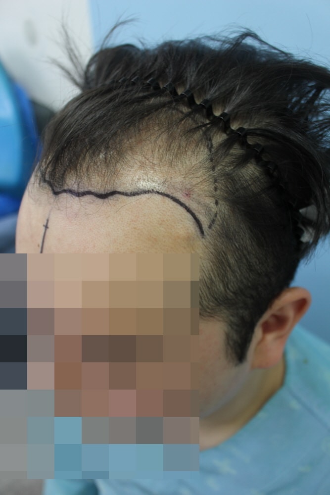 이식 3.JPG