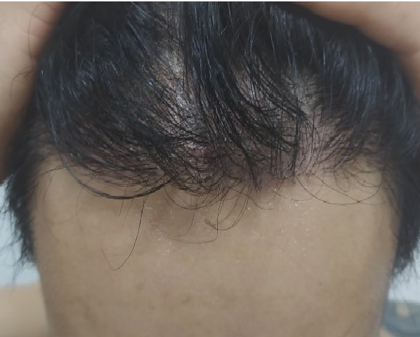 [モディヘアプラント医院] モディヘア6ヶ月目の経過です。