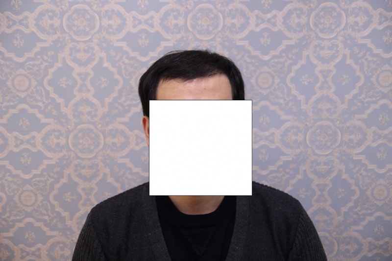 수술4개월후정면-크기조정.jpg