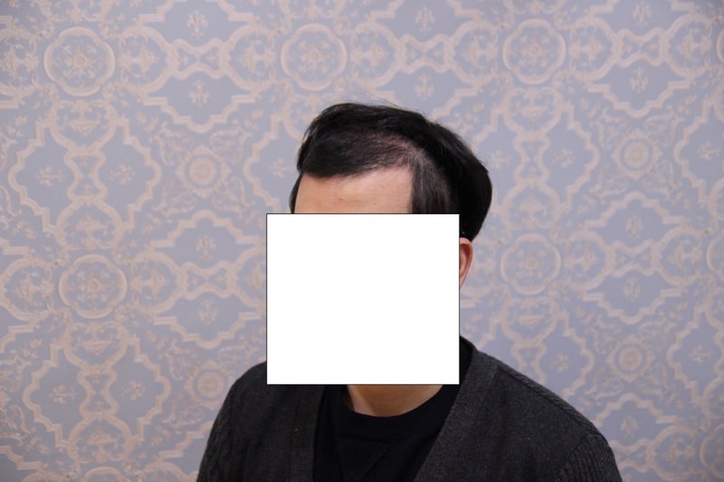 수술4개월후좌측-크기조정.jpg