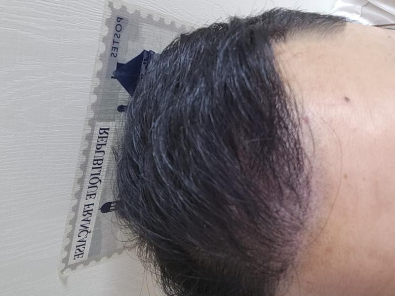 是1年1个月的毛发移植后期~~~barbershop最棒哦