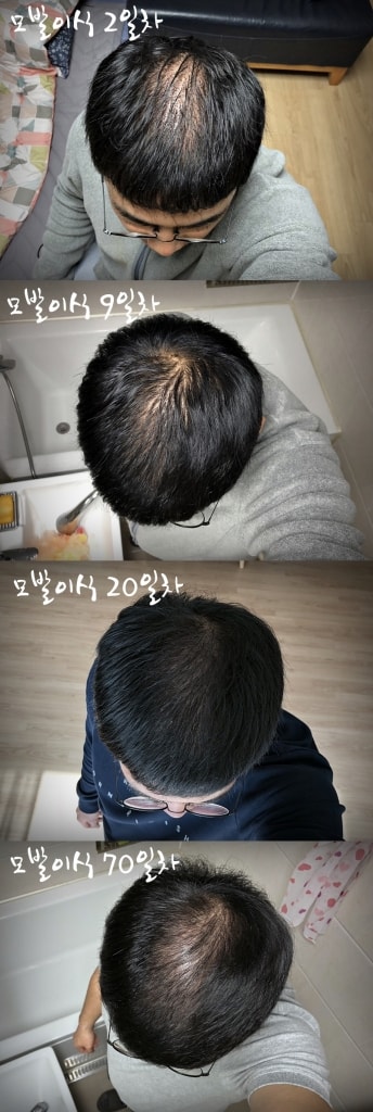 모발이식.jpg