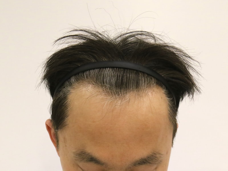 부산모발이식 슬릿방식 맘모스 M자 8개월 경과