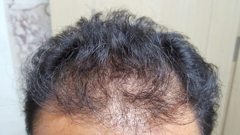 Day 30 of non-cut 1800 hair follicles