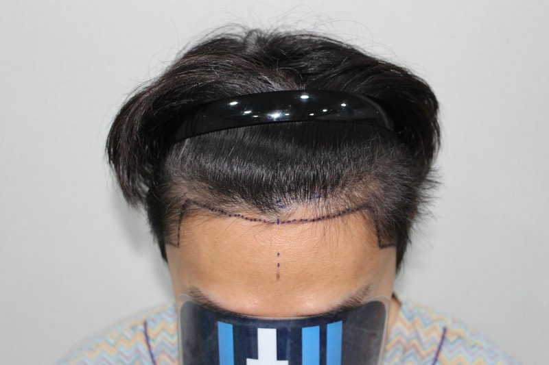 모더함의원 남성 비절개 모발이식 수술 다음 날 후기[비절개 모발이식]