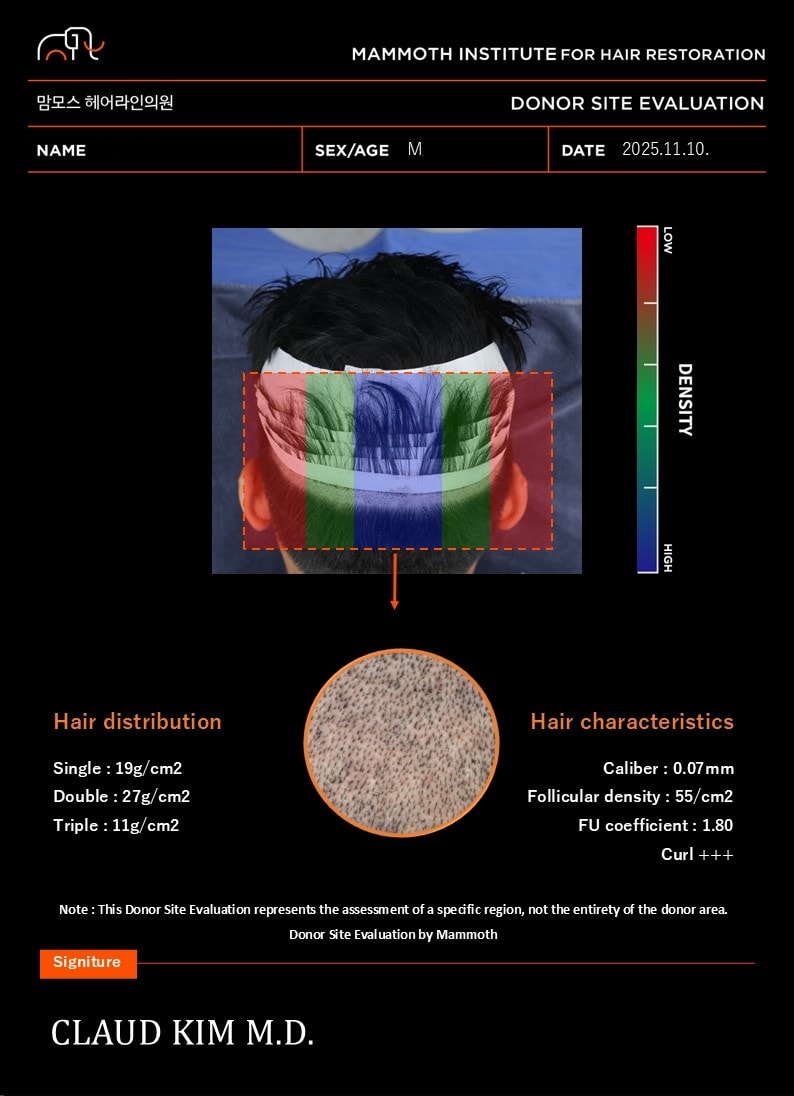 부산맘모스헤어라인 비절개 1159모낭 M자+전두부 수술당일후기