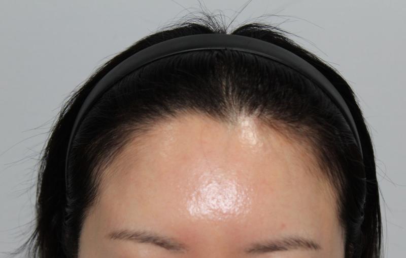 女性950毛包 ヘアラインのレビューを書きます。
