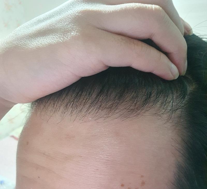 모플러스 3500모 비절개 170일차 경과체크