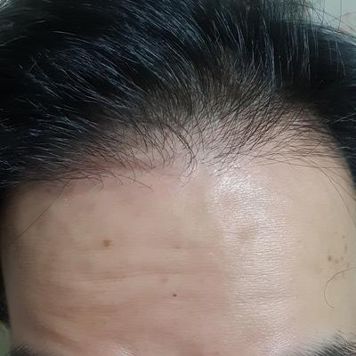 모플러스 비절개 3500모 7개월 경과 후기
