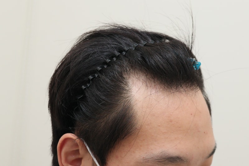 1. 수술전_3.JPG