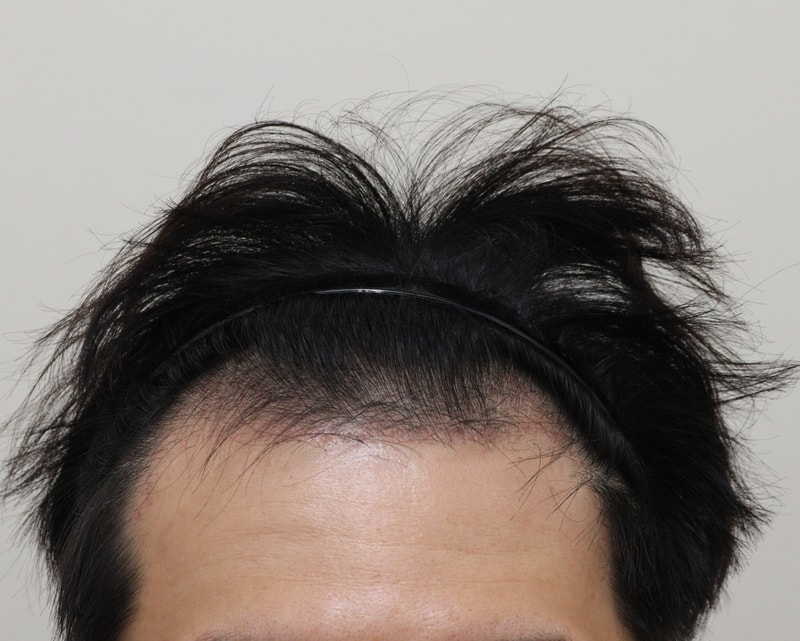 3. 수술후_3개월_1.JPG