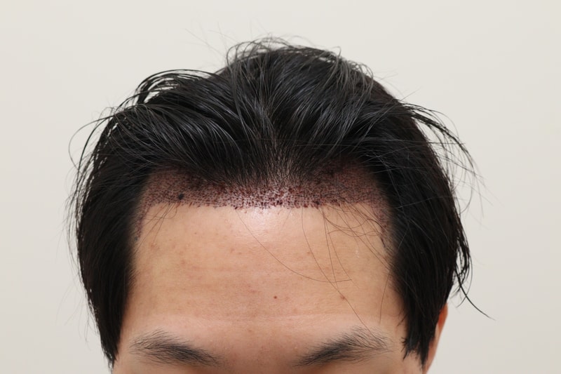 2. 수술후_1일.JPG