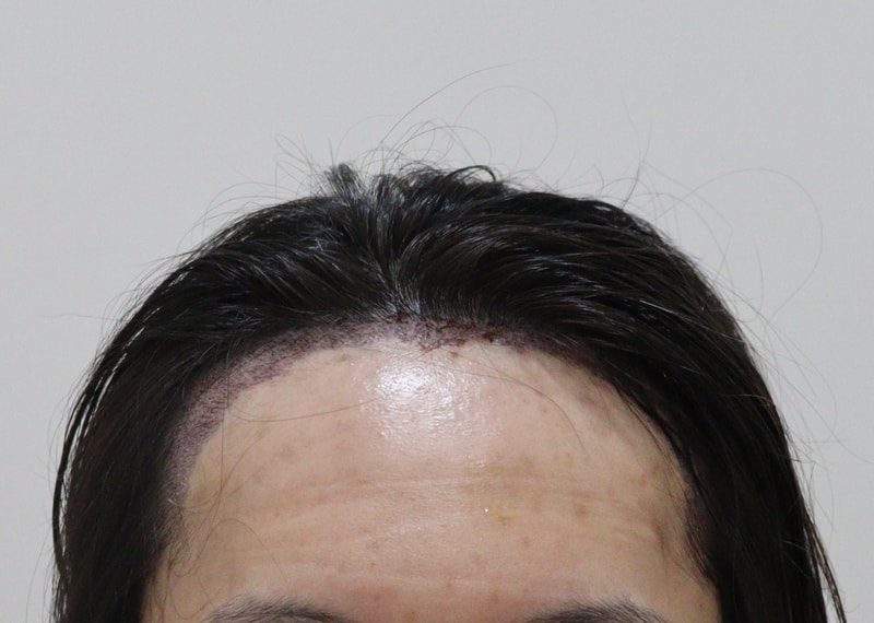 2. 수술후_1일_1.JPG