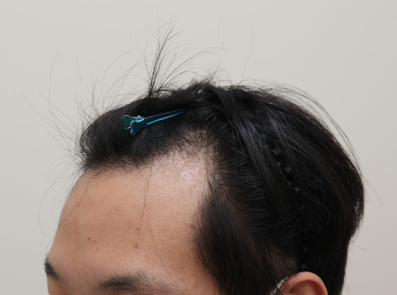 1. 수술전_2.JPG