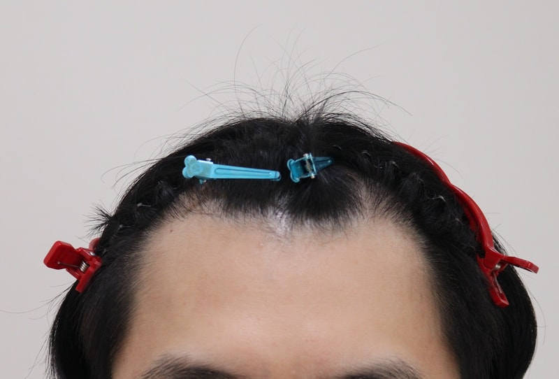 非切開で再手術を受けてみました.. いいですね