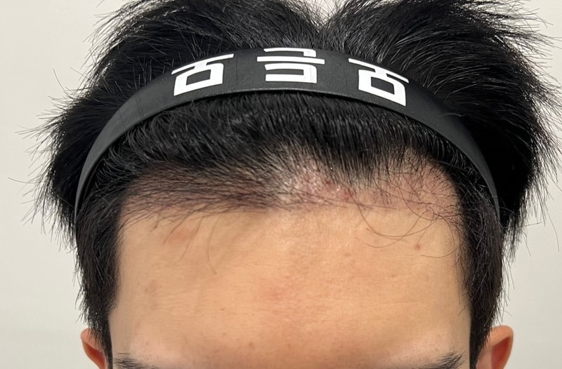 3. 수술후_3개월_1.jpg