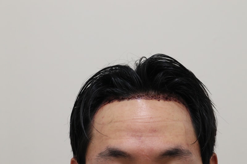 2. 수술후_1일_1.JPG