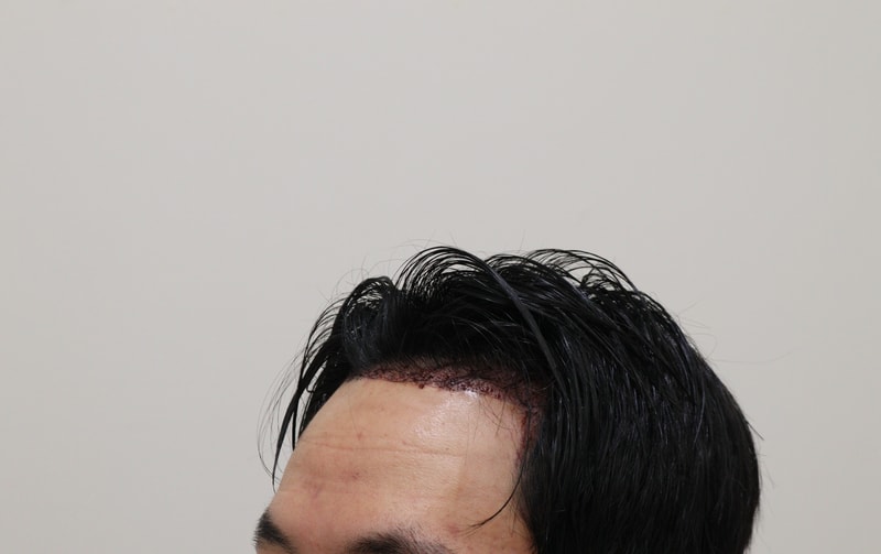 2. 수술후_1일_2.JPG