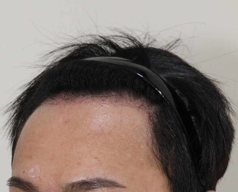 3. 수술후_3개월_3.JPG