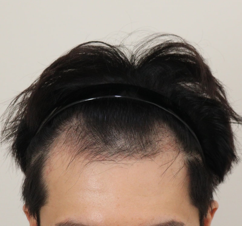 3. 수술후_3개월_2.JPG