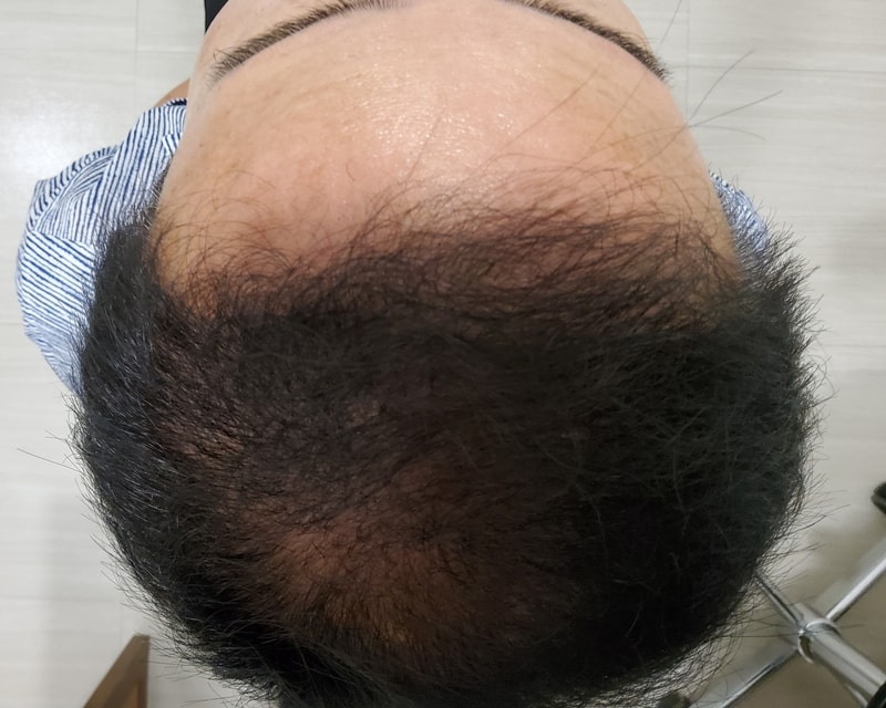 5. 수술후_6개월_3.jpg