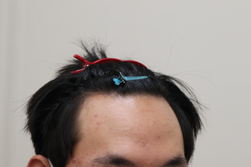 1. 수술전_4.JPG