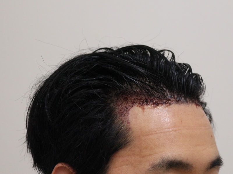 2. 수술후_1일_3.JPG