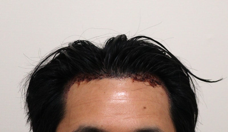 2. 수술후_1일_1.JPG