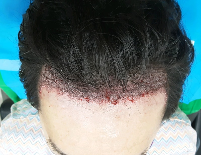 2. 수술직후_1.jpg