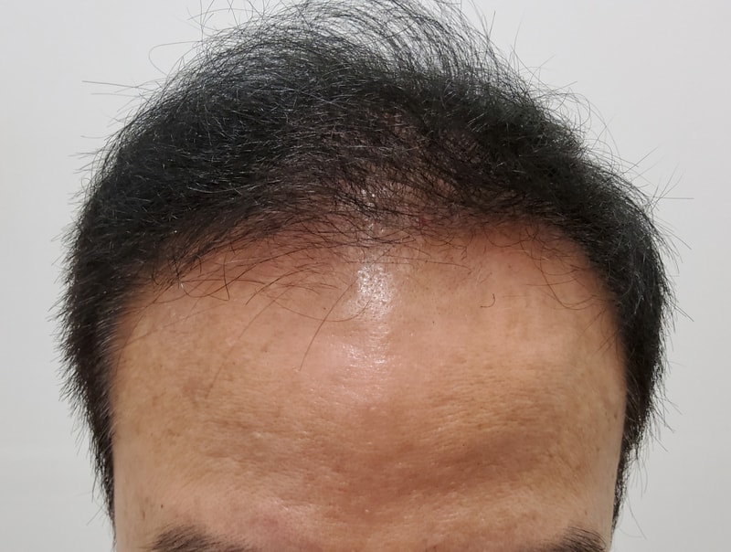 5. 수술후_6개월_1.jpg