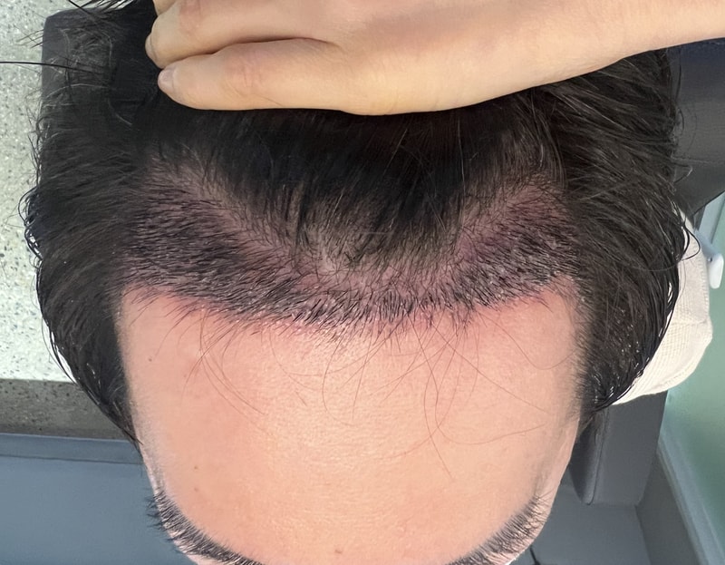 2. 수술후_2주_1.jpg