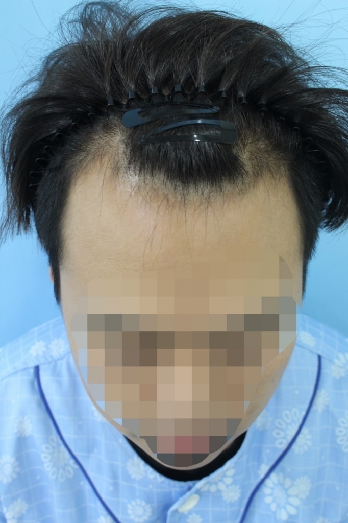 ハンナイブM字切開2300毛の手術直後です。