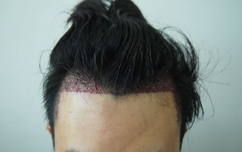 수술후1.JPG