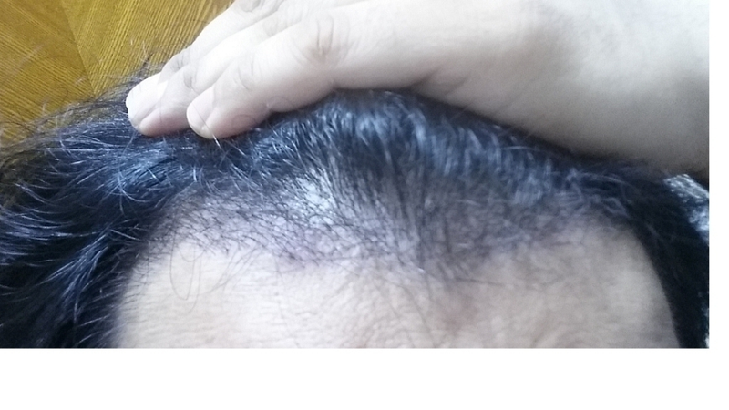 수술후17일.png