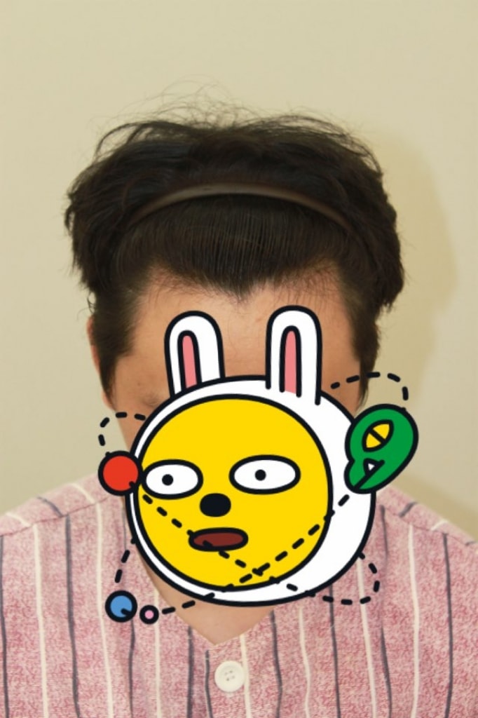 FOHAIR新论岘非切开无剃头M字少量移植