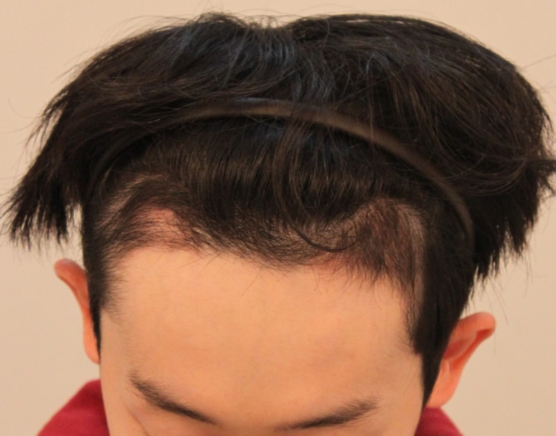 Sinnonhyeon Branch Small Amount Transplantation 3