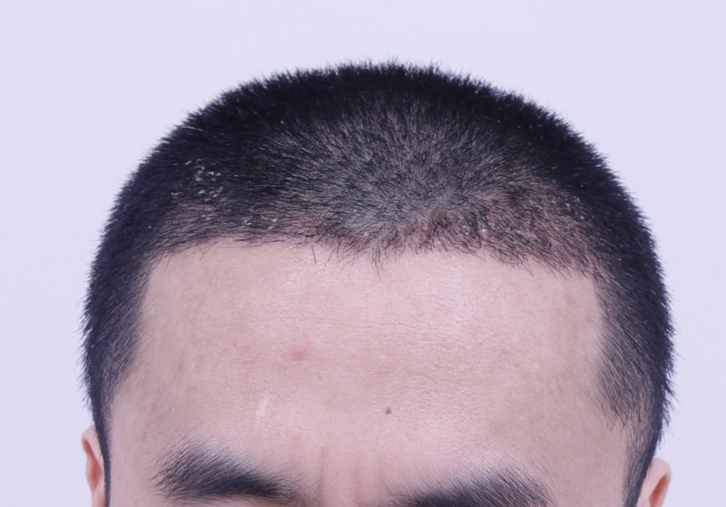 非切开缝隙手术已经4个月了