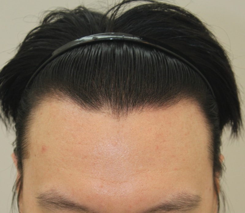 非切開手術で4ヵ月になります