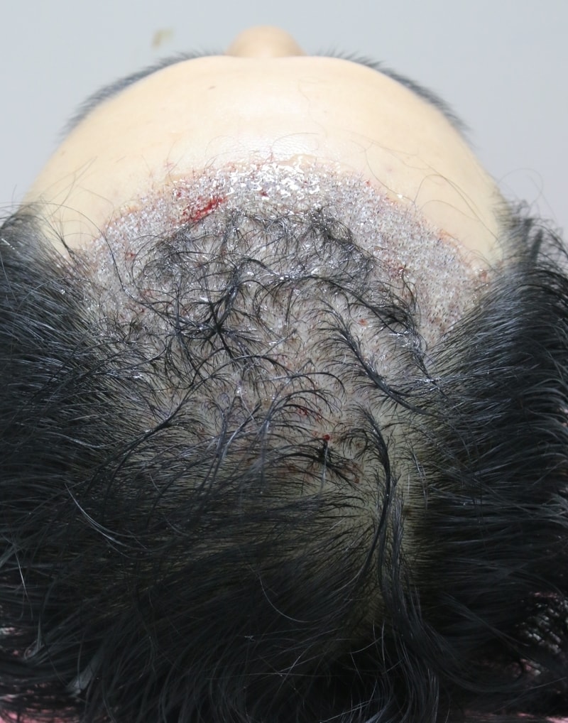 It's a review of 3 months of hair follicle surgery
